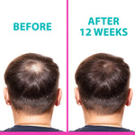 Load image into Gallery viewer, T2 Hair Loss Leave In Vials for Weak and Fine Hair (12 vials x 0.27 fl oz) Natural Hair Growth Oil Scalp Treatment for Women and Men Intensive Root Strengthening Treatment with Peppermint Rosemary and Castor Oil by